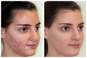 microderm-before-after