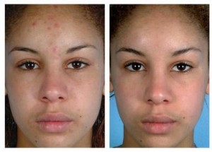 microdermabrasion-before-and-after